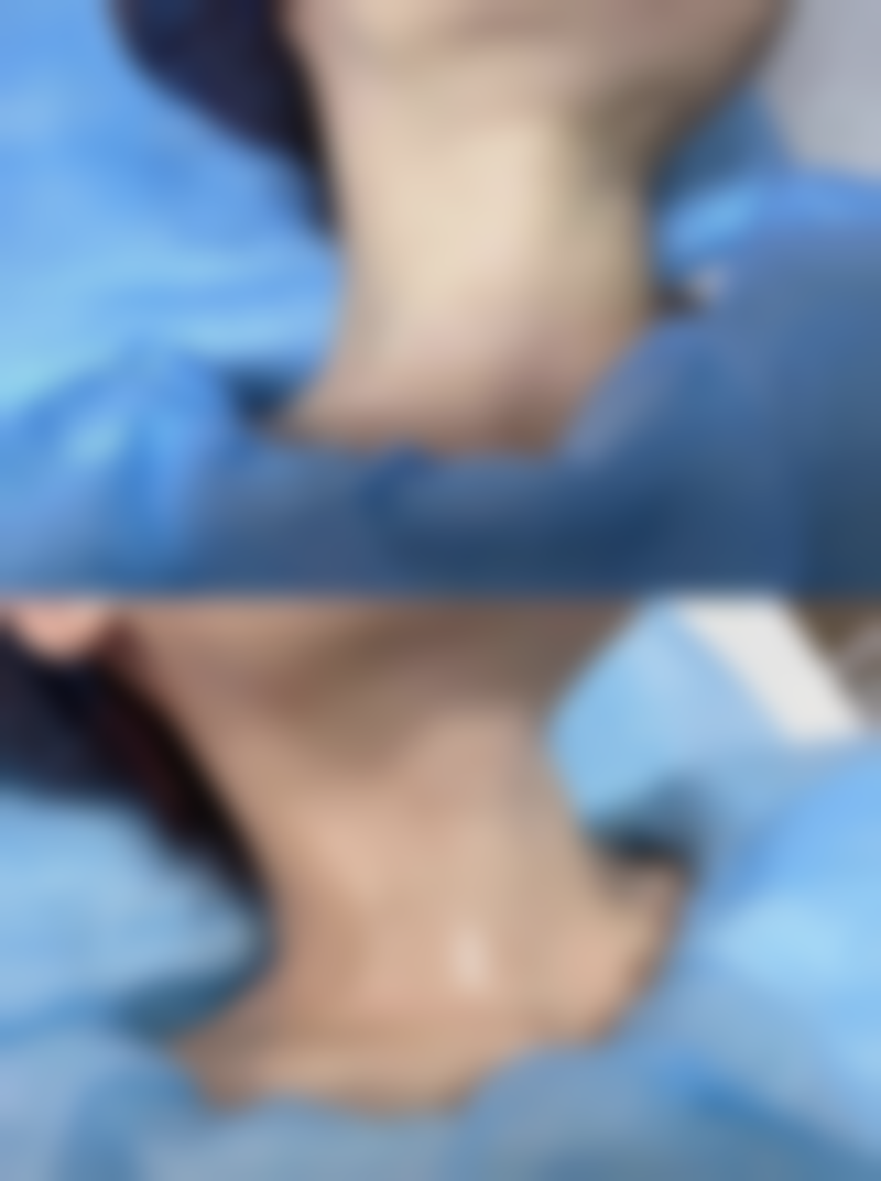 术后护理避坑指南,让毛囊存活率拉满