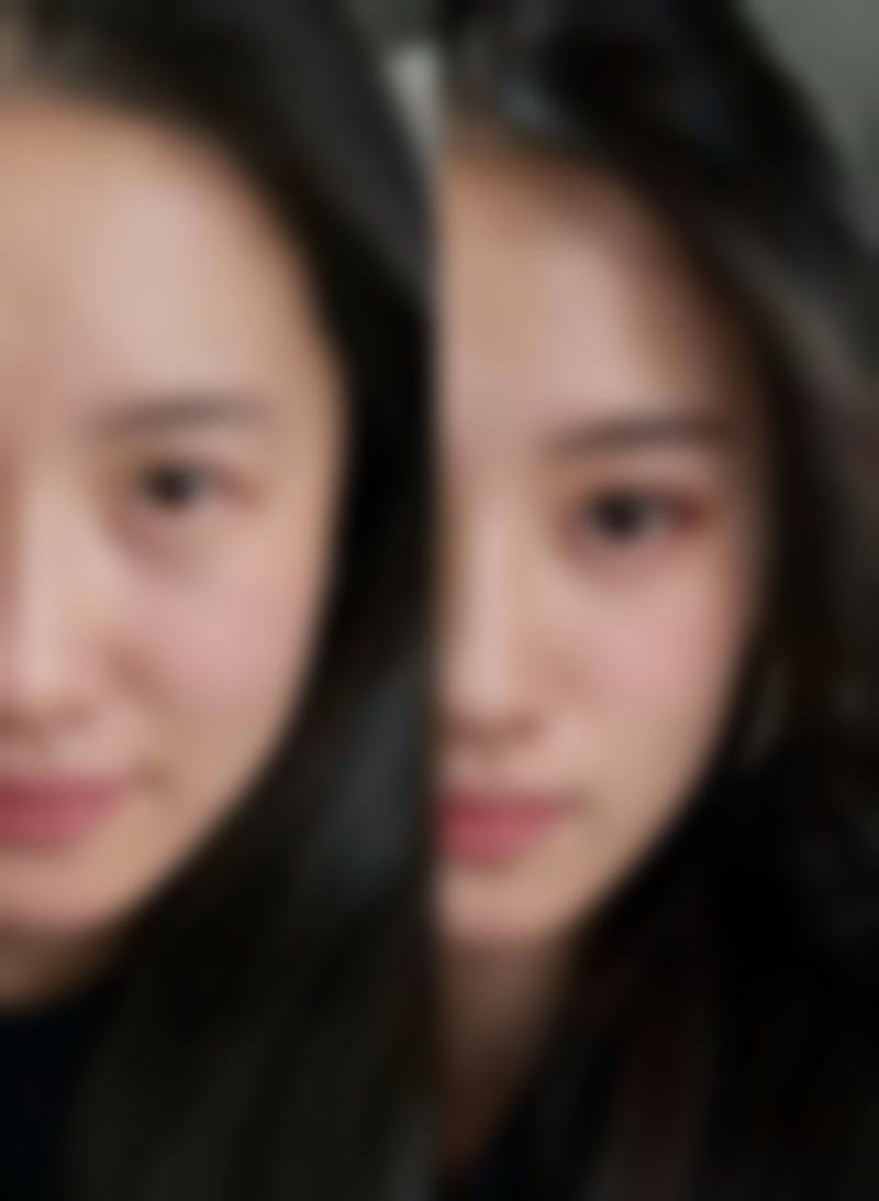 头发种植毛囊怎样取出来?两种主流技术全解析