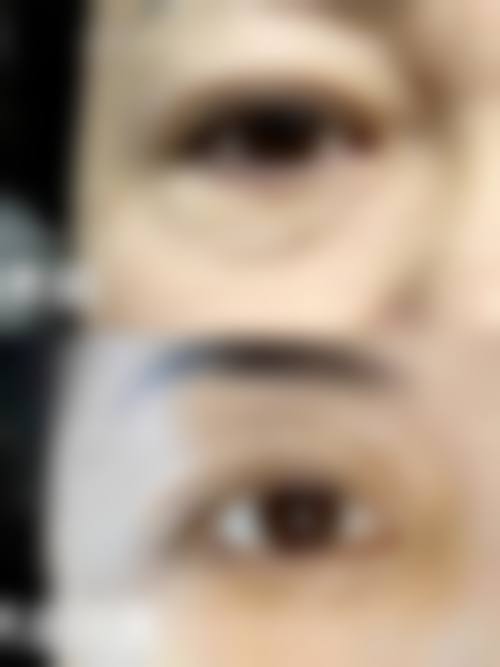 哪些人群在评估中更可能被建议考虑按摩加眼霜去除眼袋?