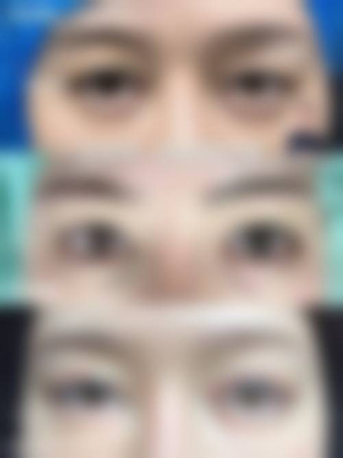 去除眼袋手术常见并发症或后遗问题,在临床中如何理解其发生概率?