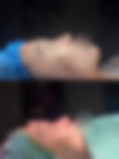 隆鼻修复时间受手术方式影响的原因