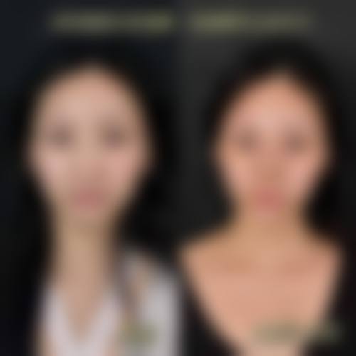 肋骨隆鼻手术成效能维持多久?