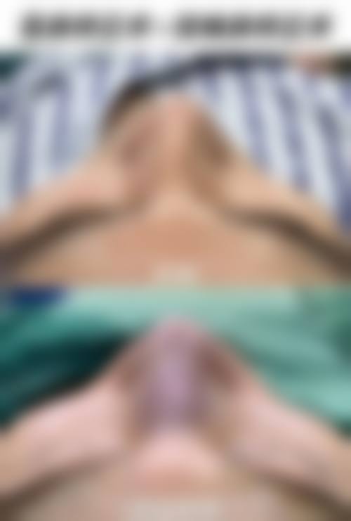 肋骨隆鼻常见并发症或后遗症,真实发生概率如何?