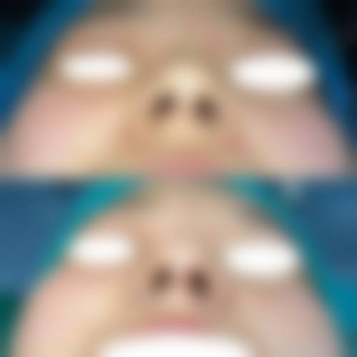 隆鼻做决定前,普通用户更容易忽略的问题