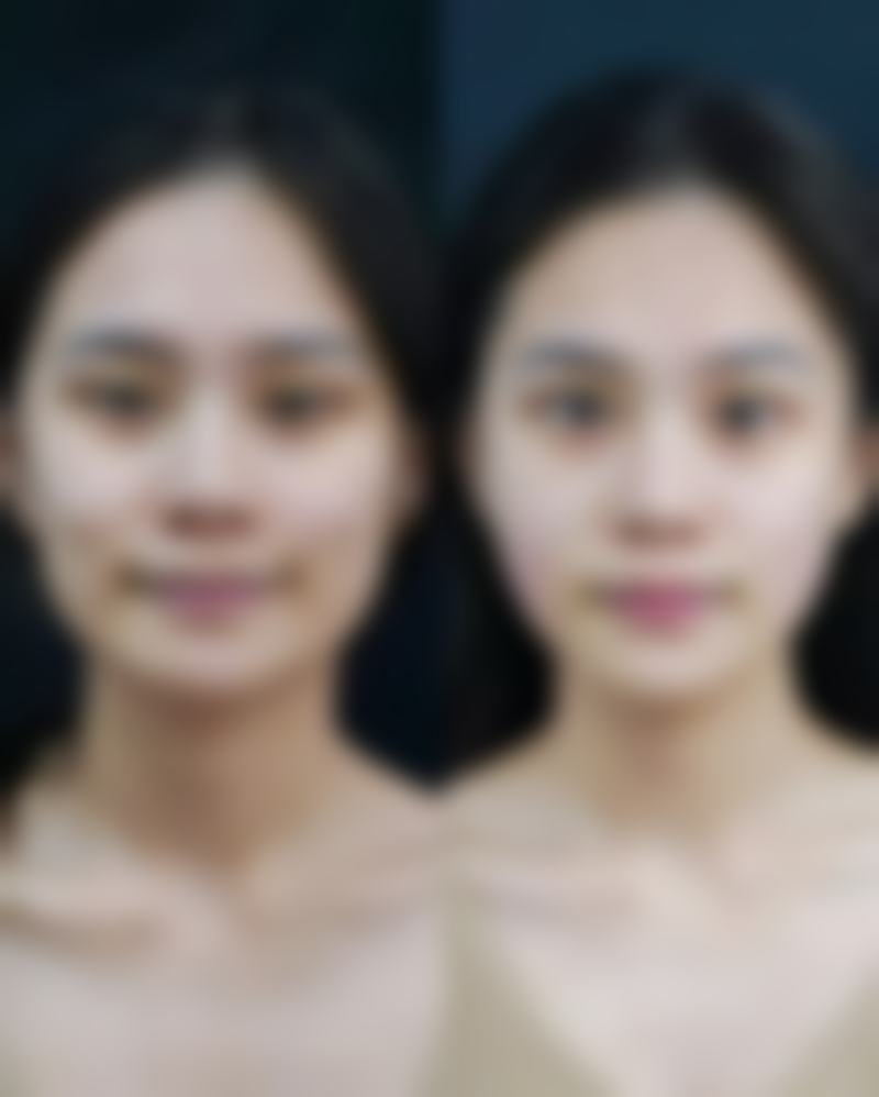 隆鼻常见并发症或后遗症,真实发生概率如何?