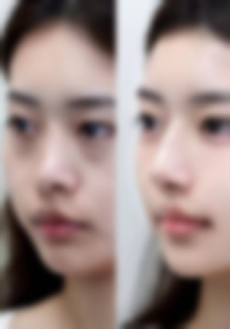 肋骨隆鼻是什么?在什么情况下会被选择?