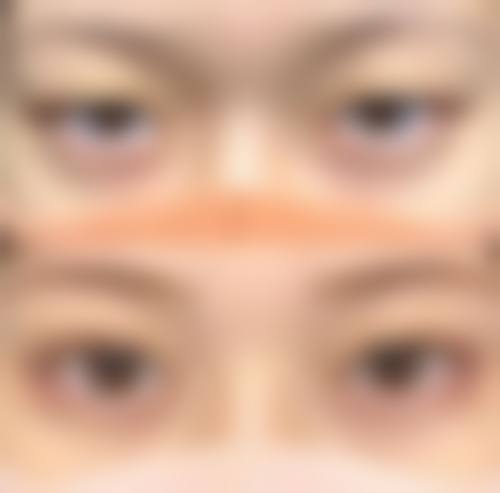 为什么双眼皮手术会出现失败或翻车情况