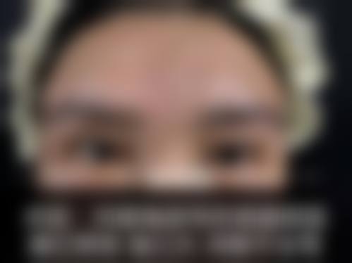 双眼皮手术在什么条件下具备修复或调整的可行性