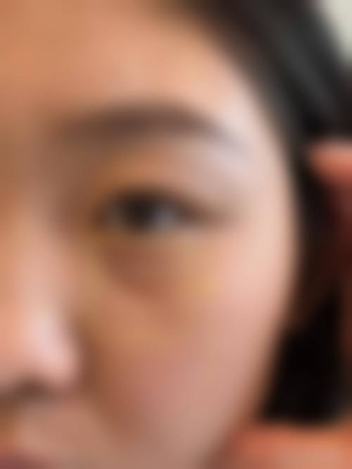 去眼袋泪沟的至佳方法是什么？在什么情况下会被选择？