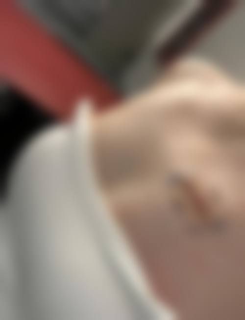 疤痕疙瘩增生药物注射的方法及注意事项