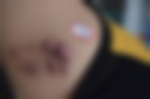 激光治疗疤痕疙瘩增生的特点