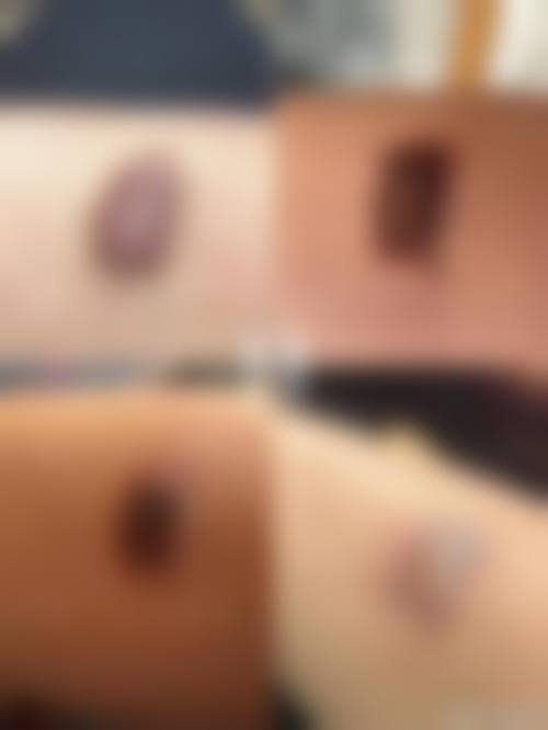 如何选择适合自己的疤痕疙瘩增生治疗方法