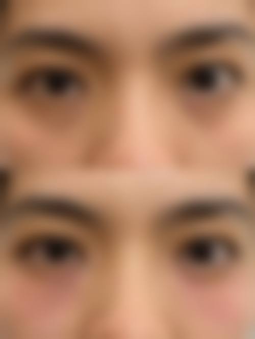 无痕去眼袋是什么？通常在什么医学背景下被选择？