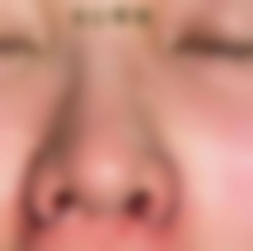 从医学角度看,15岁隆鼻手术的风险主要集中在哪些环节?