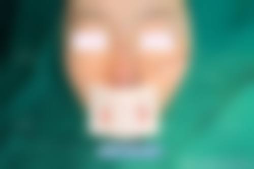 在决定是否选择15岁隆鼻手术前,普通用户更容易忽略的关键评估点