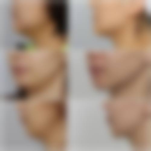 如何确定打瘦脸针后可以化妆的正确时间