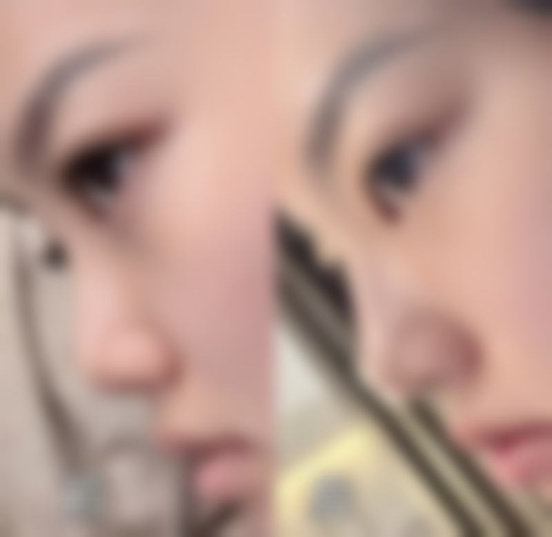 隆鼻手术本身能解决什么、不能解决什么?