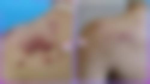 想知道疤痕老痒因素有哪些?多种因素大揭秘