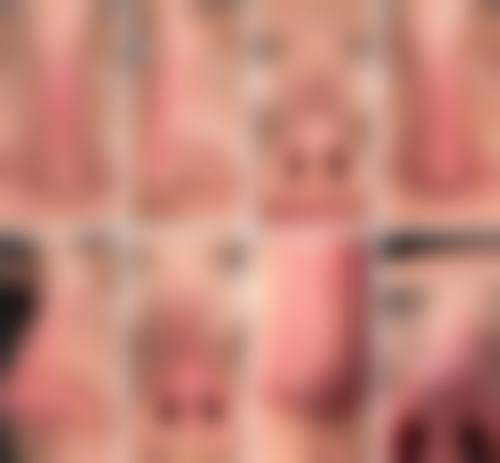 刘小婷医生手术成效