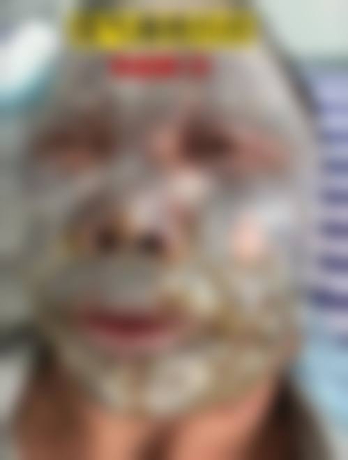 龙游盛熙妍整形医院真实实例参考