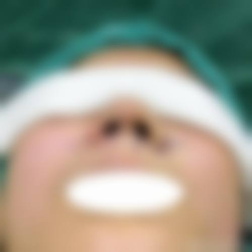 哪做耳软骨隆鼻效果好？兰州时光赵磊医生技术成熟，12980元打造自然持久美鼻！