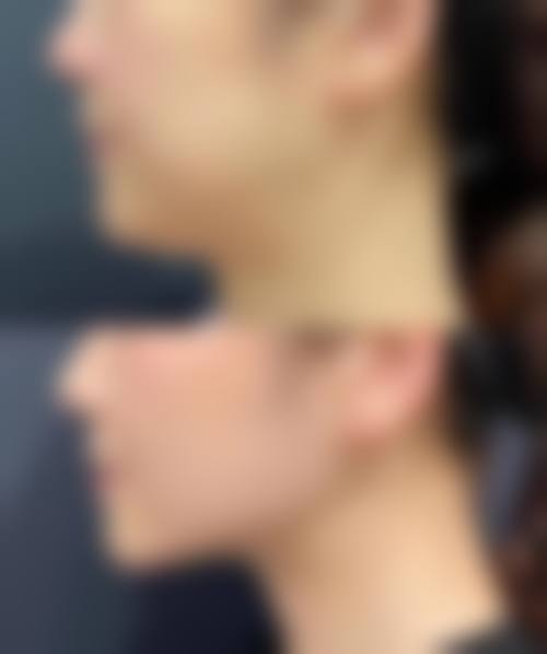 八、打瘦脸针的成效稳定性取决于哪些因素?