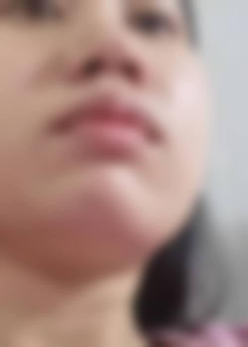 三、从医学角度看,打瘦脸针的核心目的是什么?