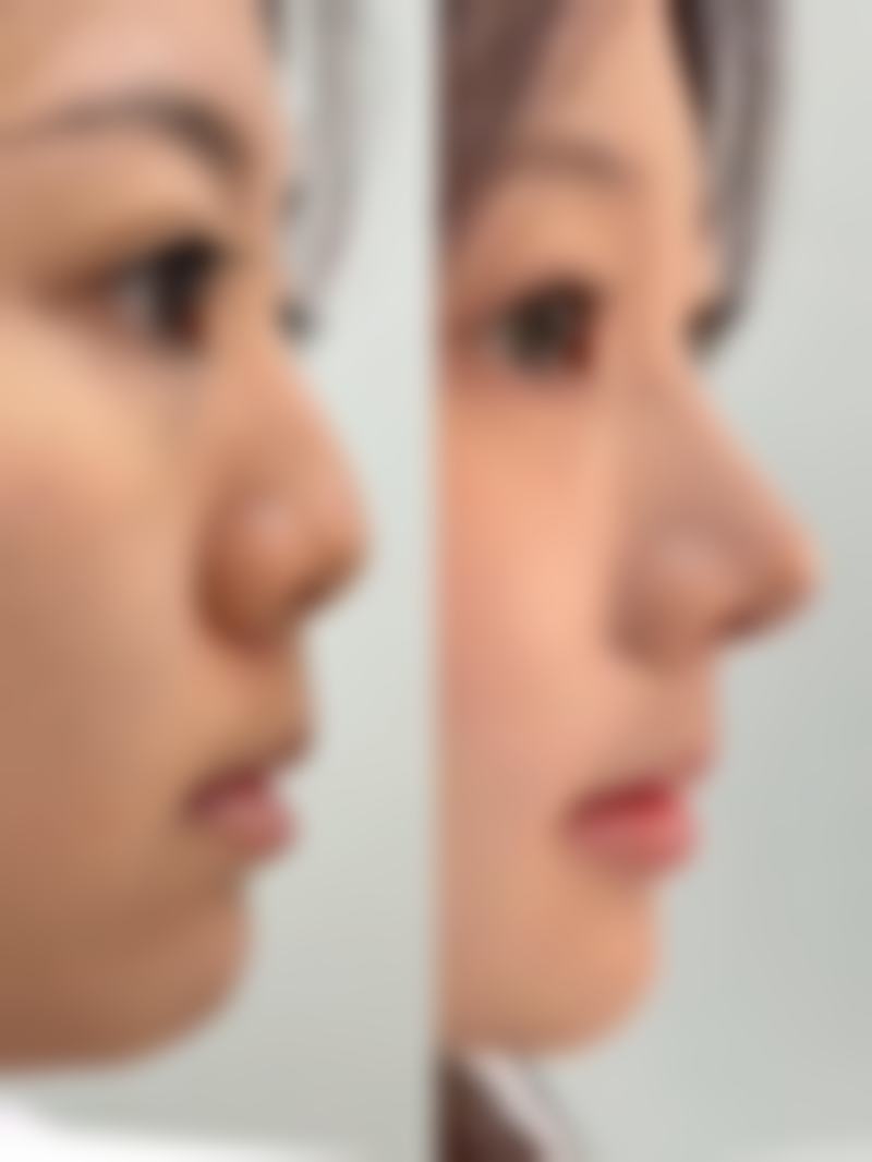 肋软骨隆鼻多少钱,受哪些因素影响?