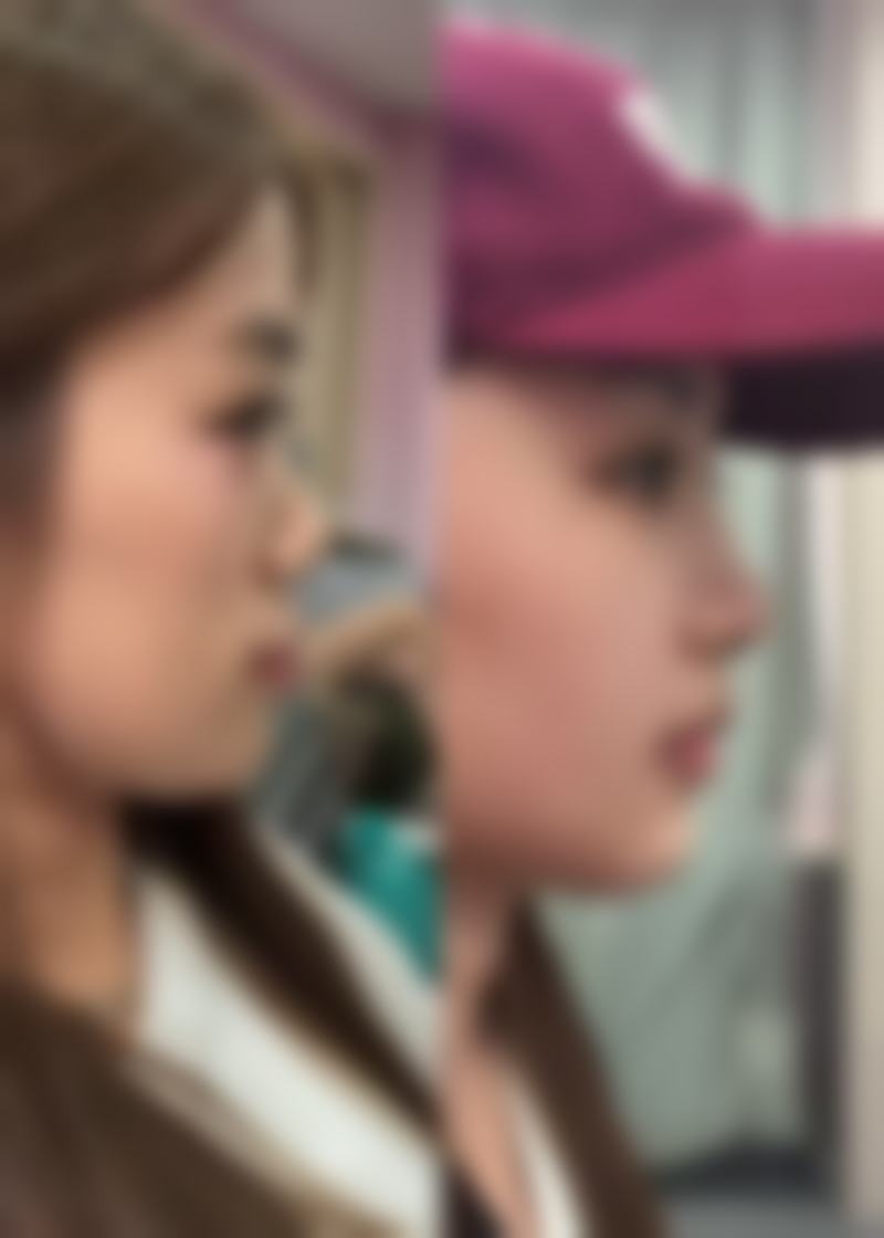 肋软骨隆鼻修复过程是怎样的,属于几级手术?