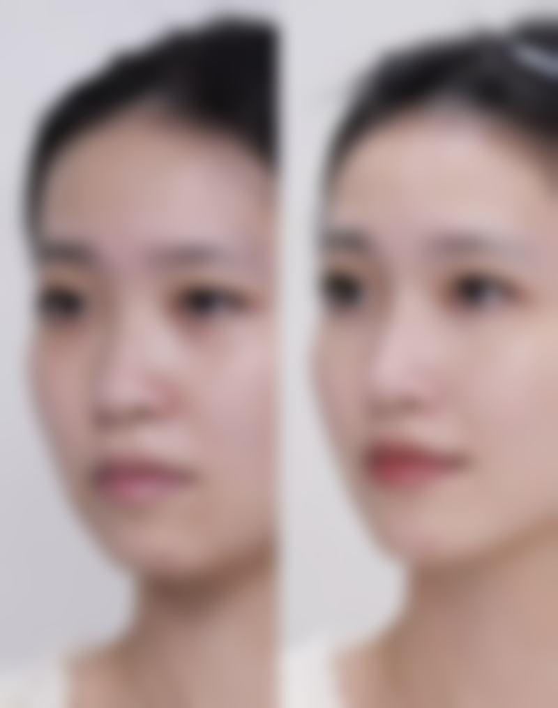 隆鼻后伤口稳定后戴眼镜可以吗？北京八大处整形医院告诉你答案