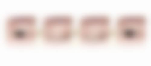 割双眼皮手术的收费价格