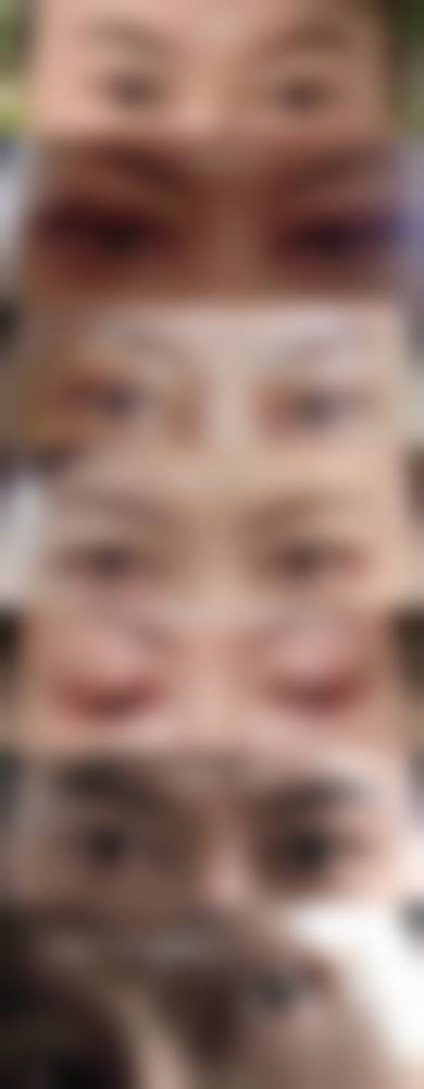 割双眼皮手术的修复阶段及护理要点