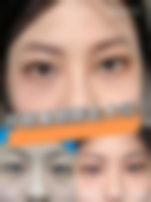 一单一双大小眼，长大后会变成两个双眼皮吗