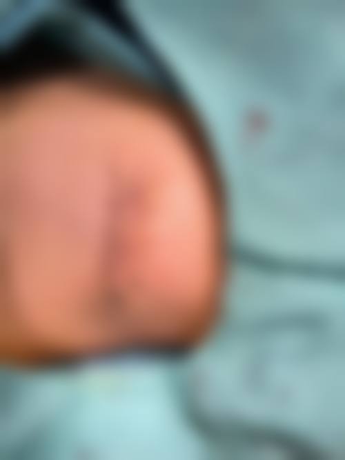 治疗疤痕增生的疤痕疙瘩是什么?