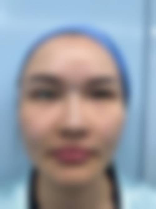 五、在实际操作中，肋骨隆鼻拆线时间更适合哪些人？