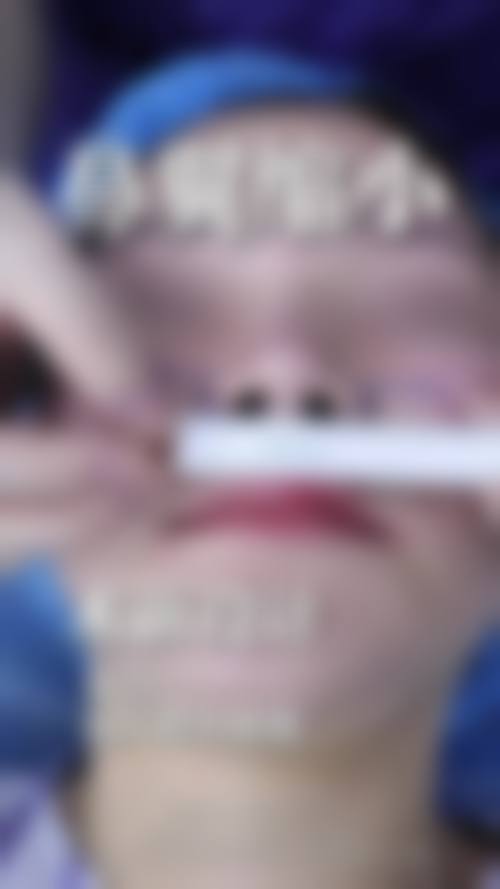 三、从医学角度看，肋骨隆鼻拆线时间的核心目的是什么？