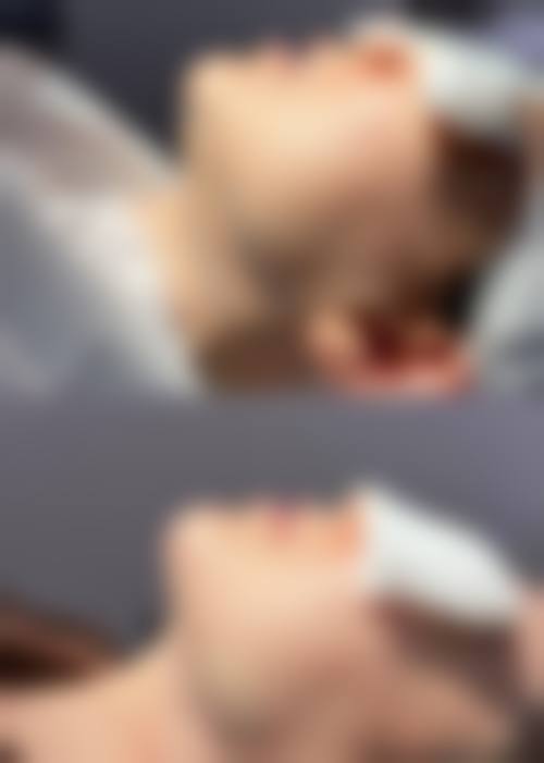 打瘦脸针皮肤松弛下垂的原因及避免方法