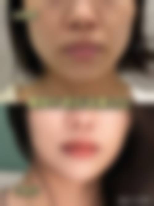 哪些人群做打瘦脸针时失败风险相对更高