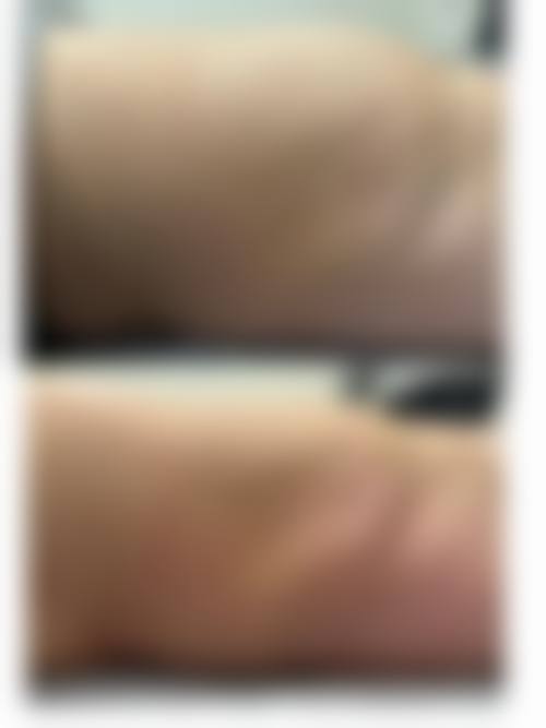 正规医院面部吸脂的技术优势体现在哪里？