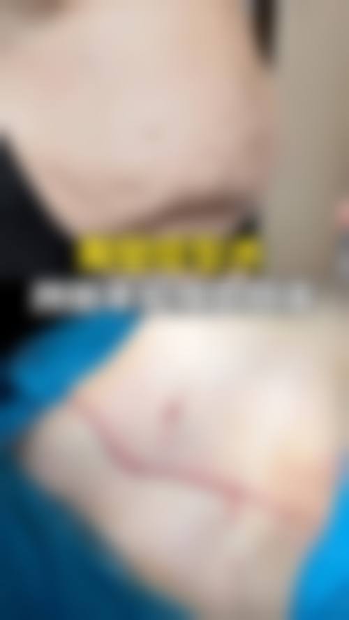 抽脂手术是如何减少脂肪细胞数量的呢？