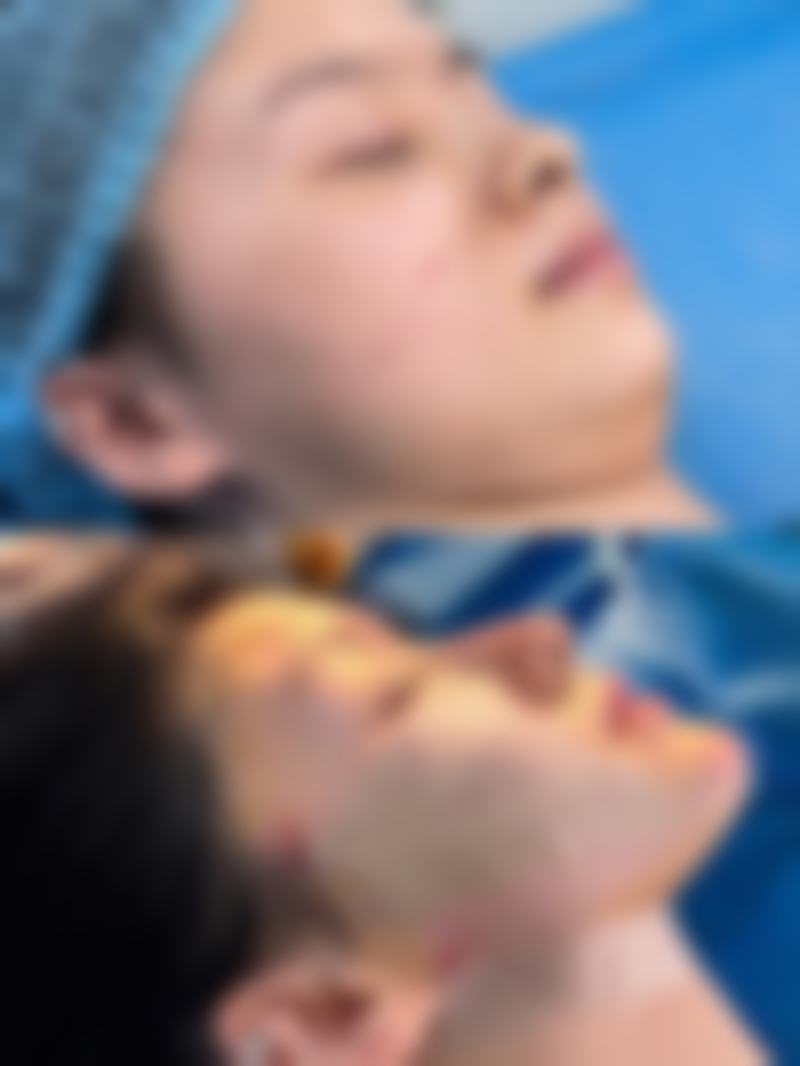 面部吸脂有哪些潜在风险，正规医院医生如何应对？