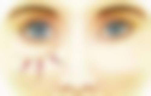 激光辅助法和微创三点定位法，哪种更适合你的多眼皮修复？