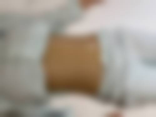 大腿抽脂的收费价格