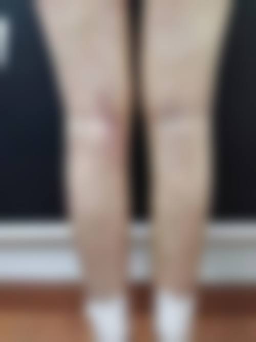 大腿抽脂的技术优势