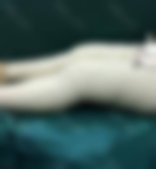 大腿抽脂一个月能运动吗