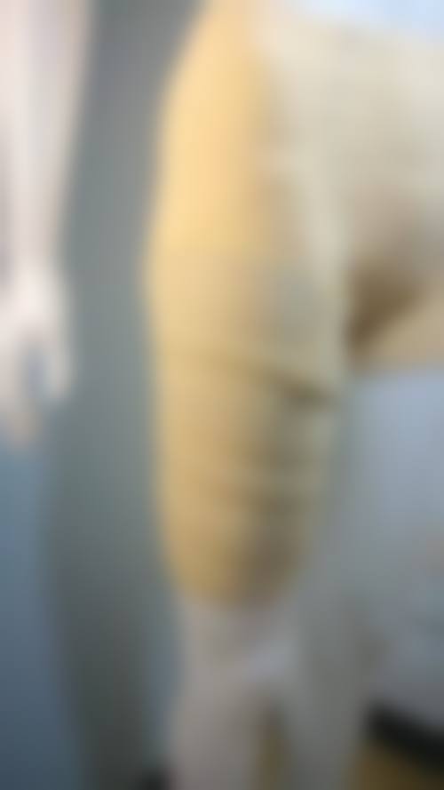 大腿抽脂一个月凹凸不平多久修复