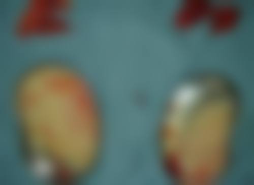 九、围绕隆胸假体取出，临床中更常见的并发问题有哪些？