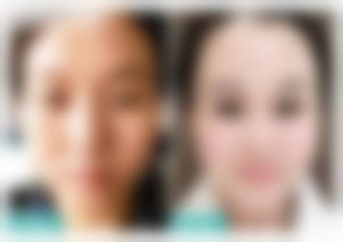 重庆面部填充技术优势解析