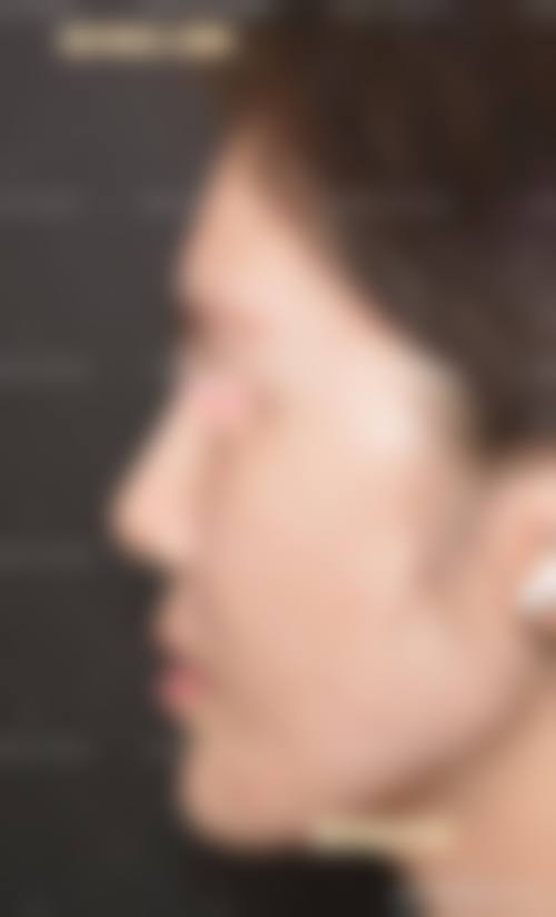 广州鼻子假体取出一般费用，价格贵不贵？能走医保报销吗？中等价位不能报！利美康粤美/军美修复技术好