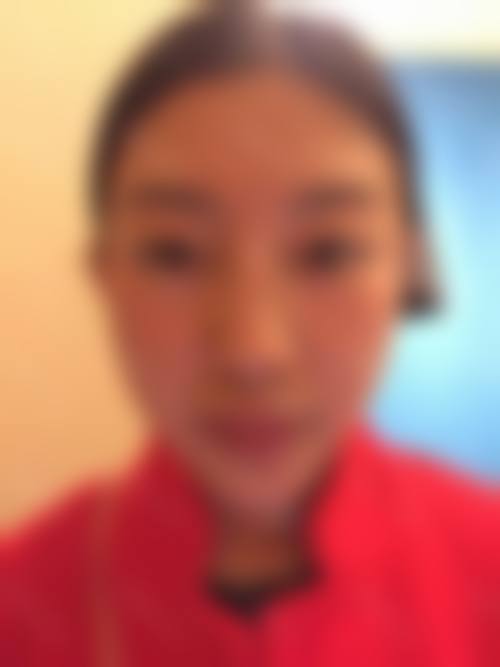 重庆面部填充口碑实例分享